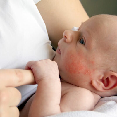Dealing with Sensitive Skin in Babies