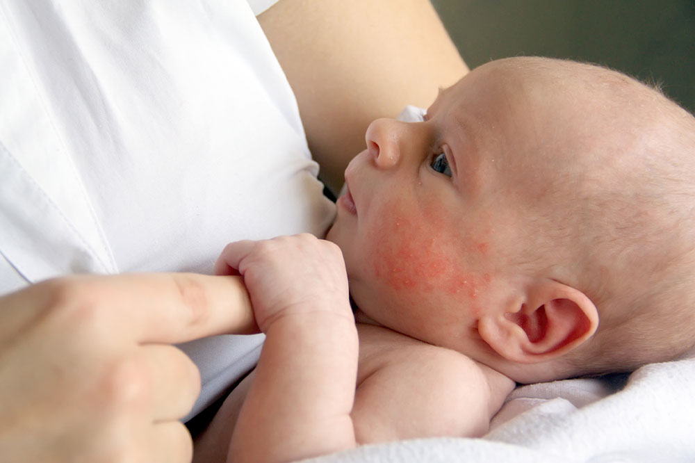 Dealing with Sensitive Skin in Babies