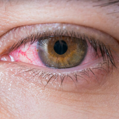 5 Viable Home Remedies for Dry Eyes