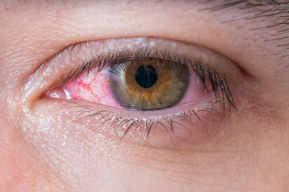 5 Viable Home Remedies for Dry Eyes